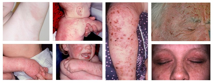 Eczema atópico: conhecê-lo para o prevenir a dermatite atópica