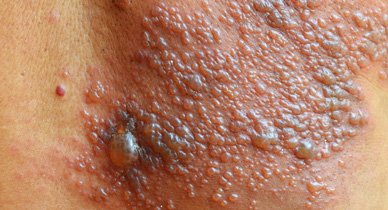 O que é o herpes e onde se desenvolve com maior frequência?