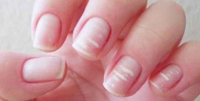manchas brancas nas unhas