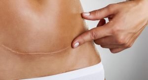 Após Parto por cesariana