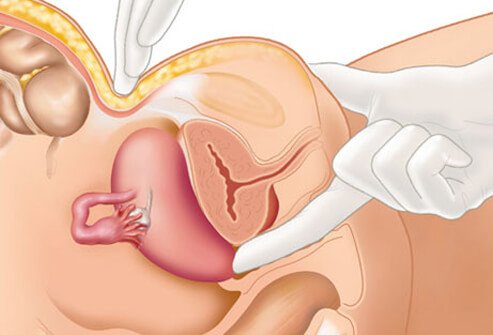 Endometriose