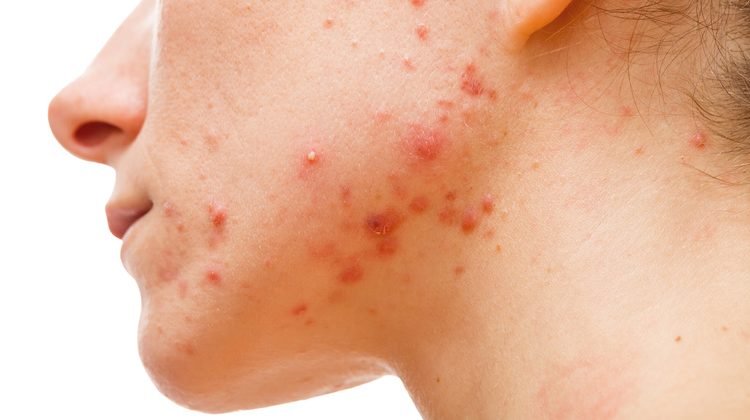 Dicas para reduzir o acne e cuidar do seu rosto