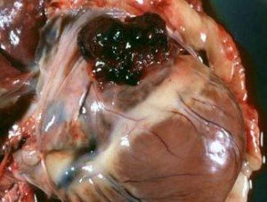tumor no coração