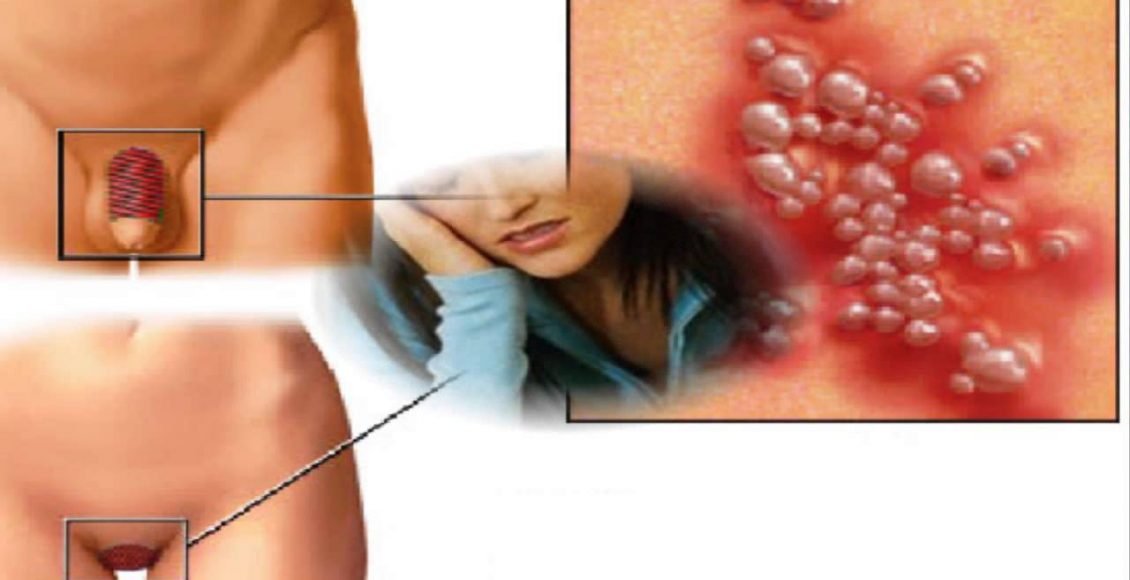 sintomas da clamídia