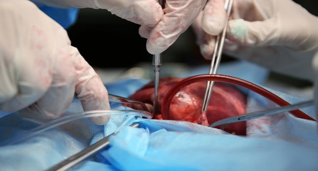 Receber um novo coração: o transplante cardíaco ou transplante de coração