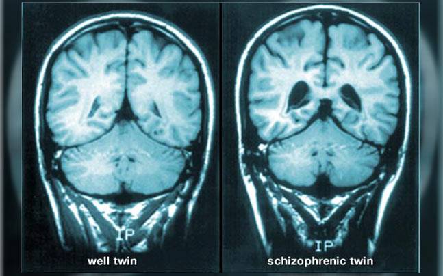 o que é a esquizofrenia