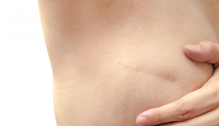 A mastectomia preventiva e o seu impacto