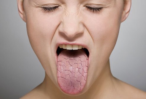 sindrome de boca seca