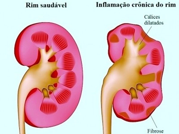 Glomerulonefrite