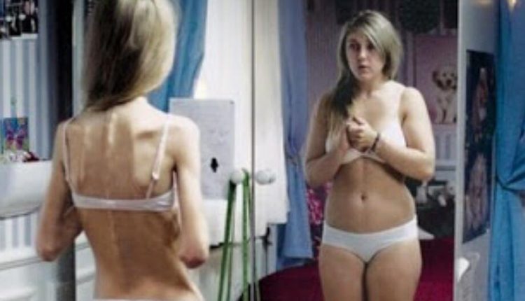 A anorexia nervosa