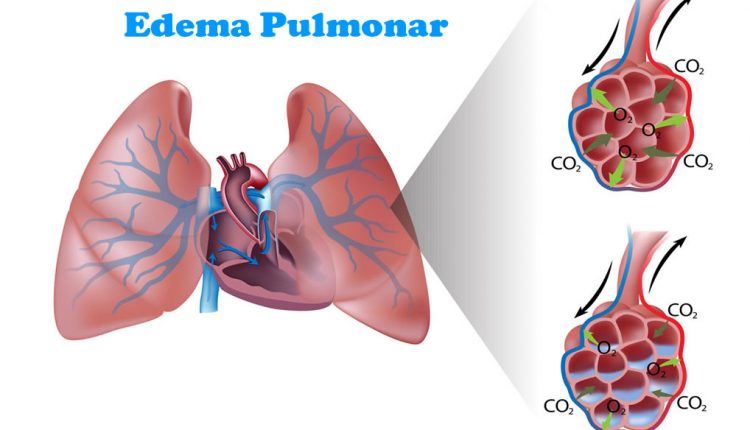 Edema pulmonar, quais as causas?