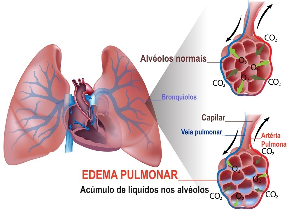 edema pulmonar