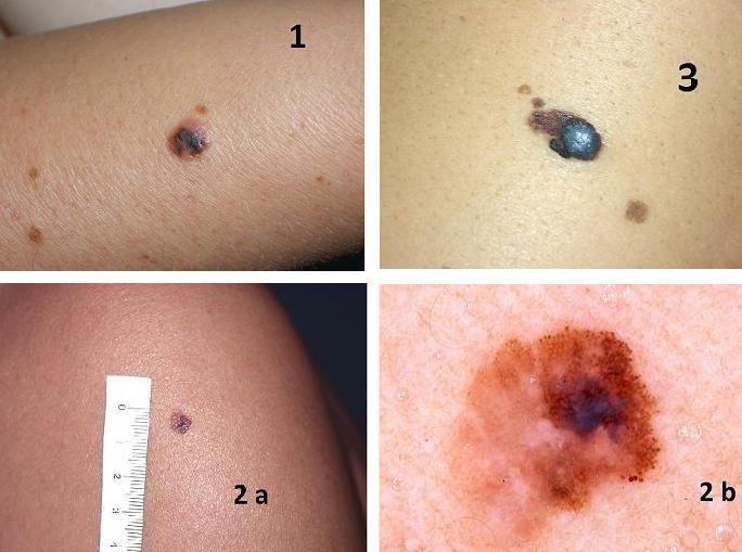 melanoma