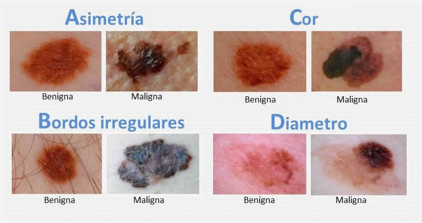 melanoma Abcde