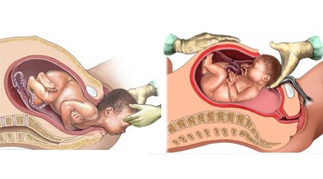 nascimento por cesariana