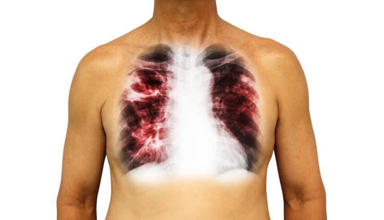 Tuberculose – Formas multiresistentes