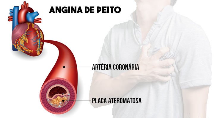 angina de peito