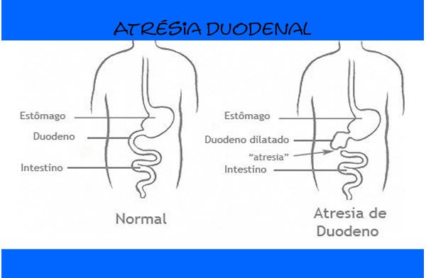 Atrésia duodenal