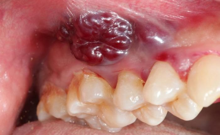Cancro Oral – Sinais e Sintomas