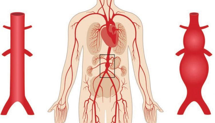 Aneurisma da aorta