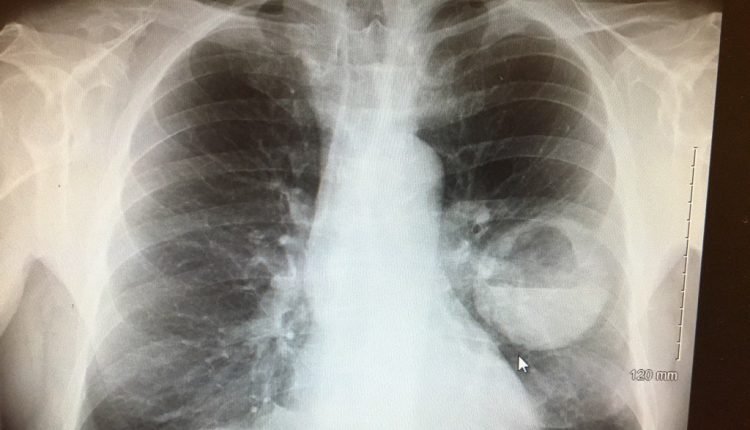 Abcesso Pulmonar