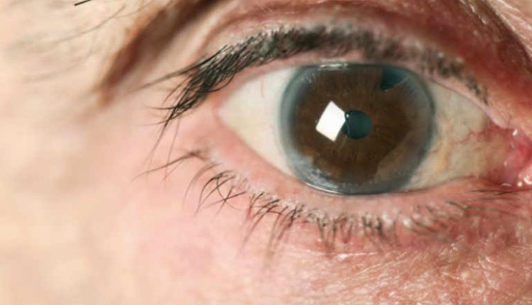 Glaucoma o que é?