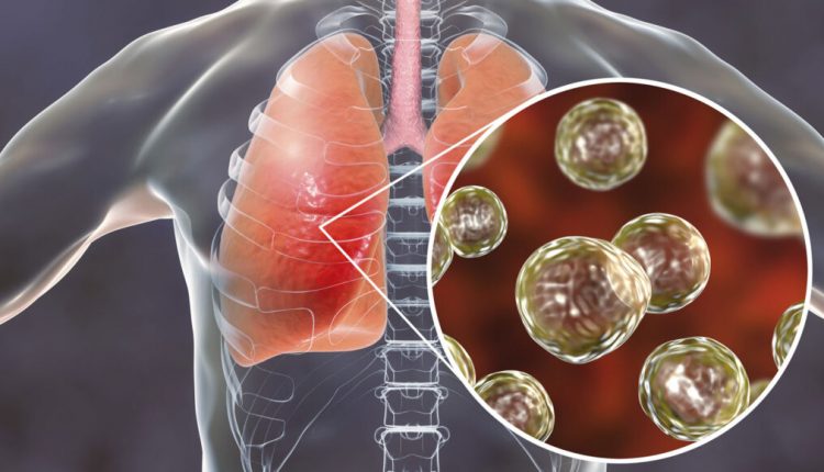 Infecção Pulmonar: Sintomas, Causas e Tratamento